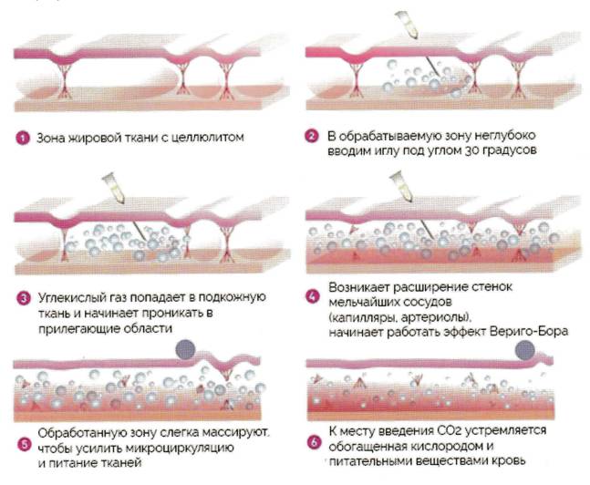 Действие карбокситерапии Действие карбокситерапии