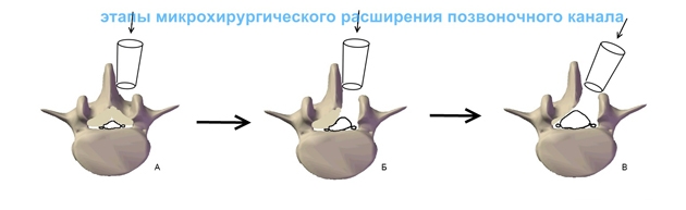 Декомпрессия позвоночного канала Декомпрессия позвоночного канала