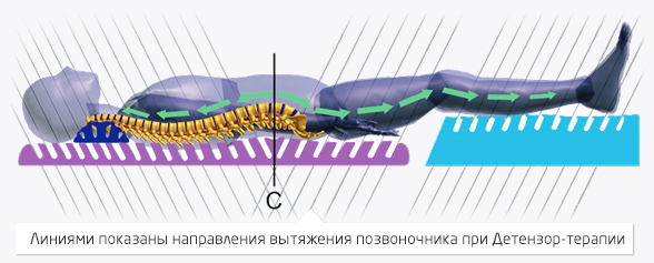 Суть вытяжения детензор-терапией Суть вытяжения детензор-терапией