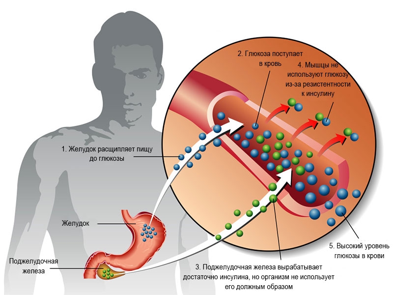 Диабет Диабет