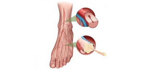 Диабет стоп Диабет стоп