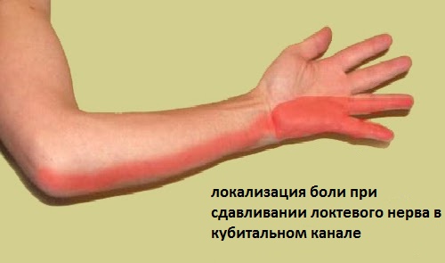 Диагностика боли при защемлении локтевого нерва Диагностика боли при защемлении локтевого нерва