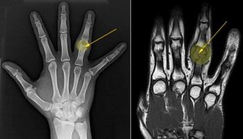 Диагностика остеобластомы на рентген снимке Диагностика остеобластомы на рентген снимке