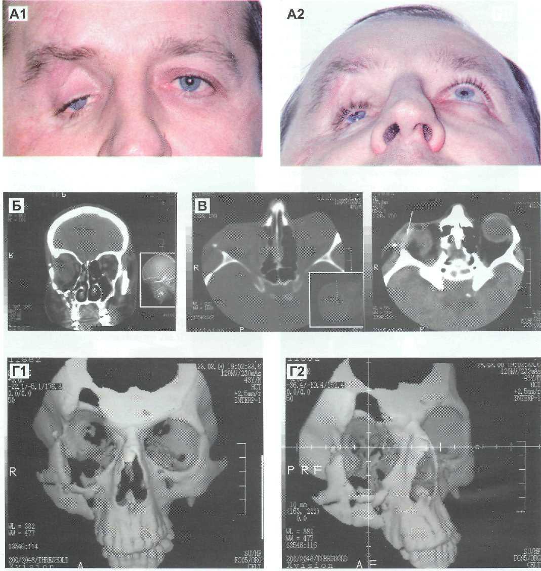 Диагностика переломов глазницы КТ Диагностика переломов глазницы КТ