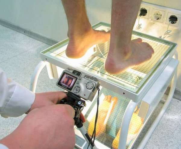 Диагностика плоскостопия в клинике