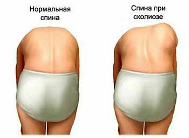 Диагностика сколиоза Диагностика сколиоза