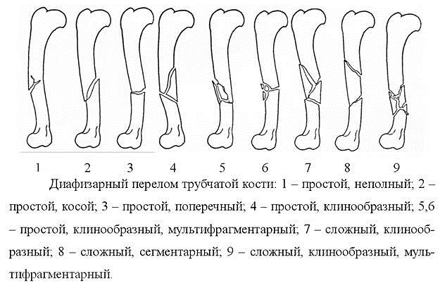Диафизарные переломы Диафизарные переломы
