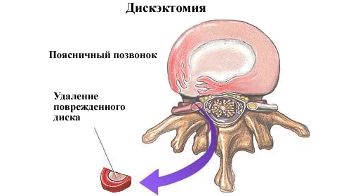 Дискэктомия Дискэктомия