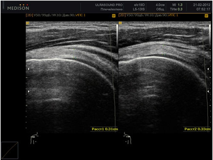 Дисплазия тазобедренного сустава на УЗИ Дисплазия тазобедренного сустава на УЗИ