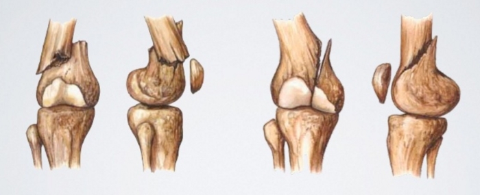 Дистальные переломы бедренной кости Дистальные переломы бедренной кости