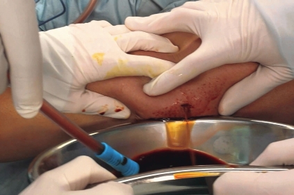 Вскрытие гематомы Вскрытие гематомы