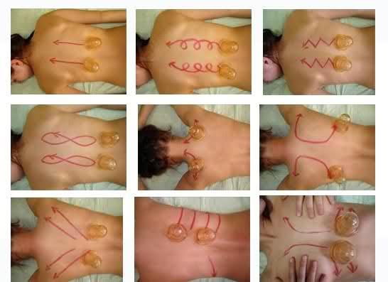 Движения при баночном массаже для лечения остеохондроза Движения при баночном массаже для лечения остеохондроза