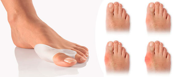 Эффект от фиксатора Вальгус про Эффект от фиксатора Вальгус про