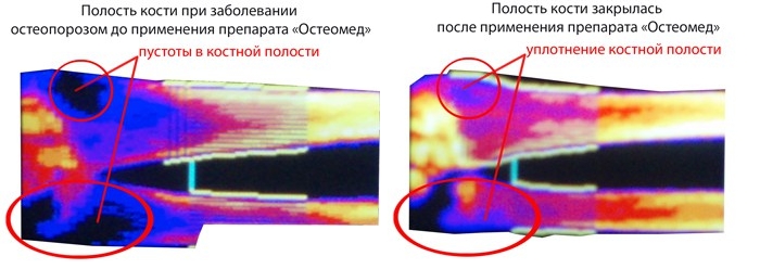 Эффективность Остеомеда Эффективность Остеомеда