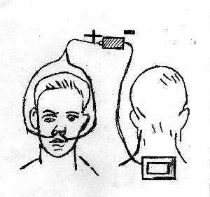 Электрофорез носа