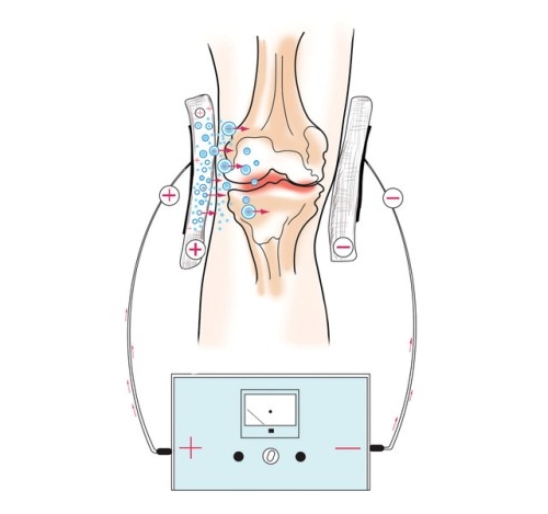 Электрофорез при ревматоидном полиартрите Электрофорез при ревматоидном полиартрите