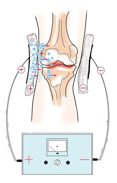 Электрофорез колена Электрофорез колена
