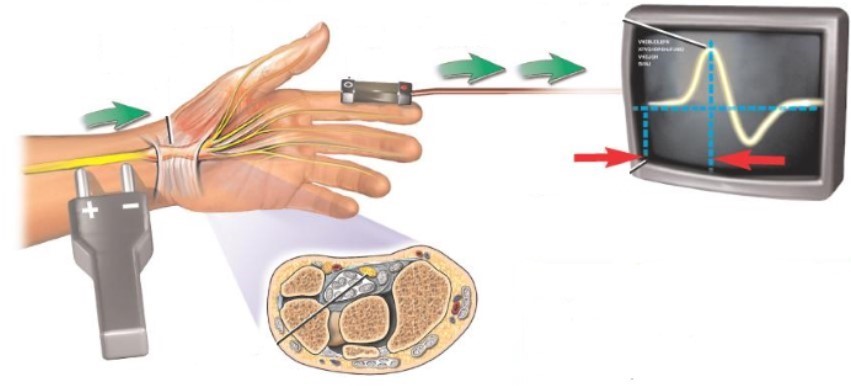 Электромиография нервов руки Электромиография нервов руки
