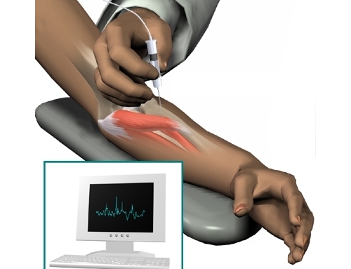 Электронейромиография игольчатая Электронейромиография игольчатая