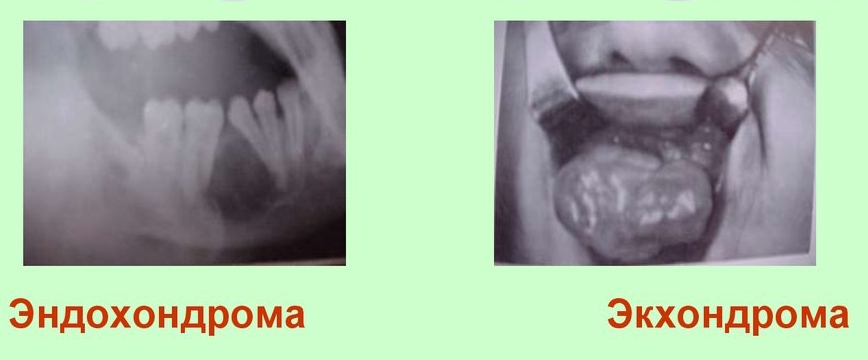 Эндохондрома и экхондрома Эндохондрома и экхондрома
