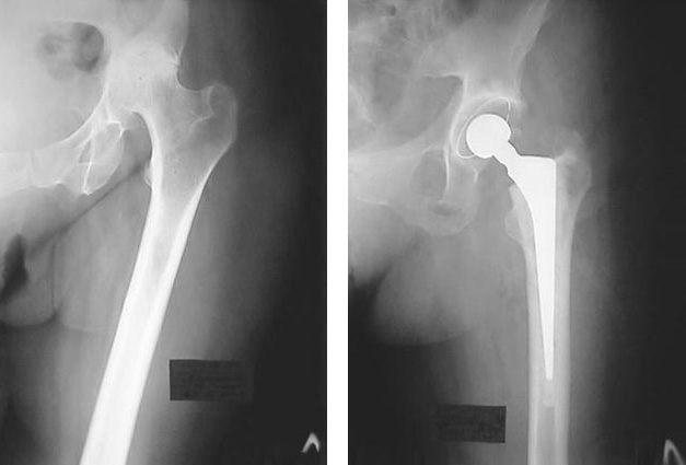 Металлический эндопротез в тазобедренном суставе Металлический эндопротез в тазобедренном суставе