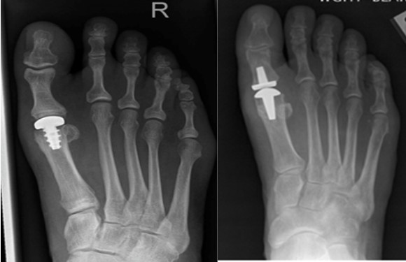 Эндопротезирование большого пальца стопы Эндопротезирование большого пальца стопы