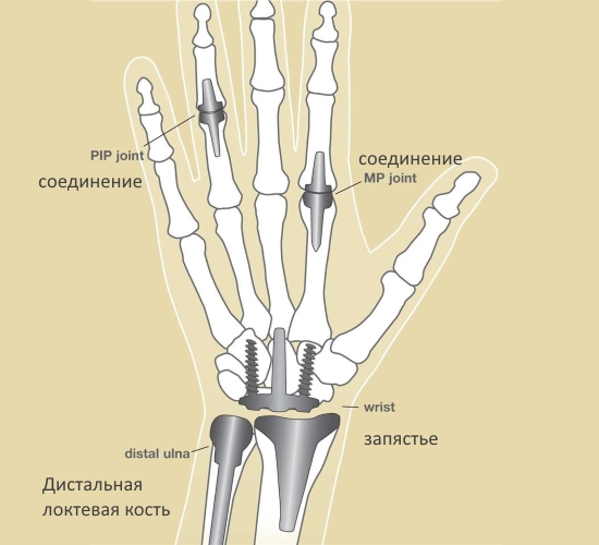 Эндопротезирование кисти руки Эндопротезирование кисти руки