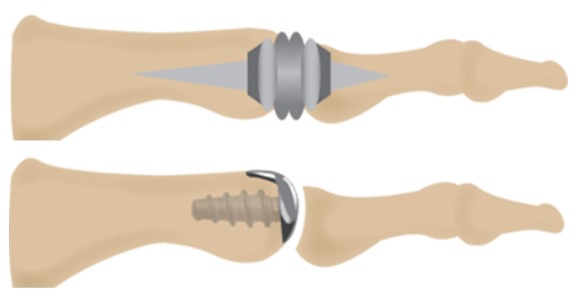 Эндопротезирование сустава пальца Эндопротезирование сустава пальца