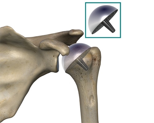 Эндопротезирование плеча Эндопротезирование плеча