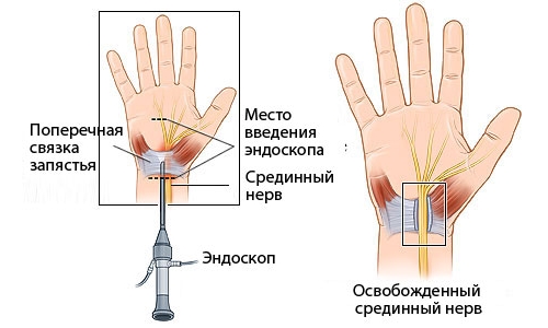 Эндоскопия запястья Эндоскопия запястья