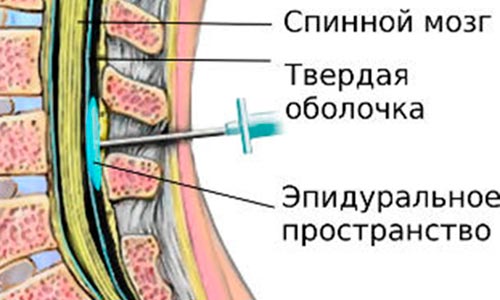 Эпидуральная блокада Эпидуральная блокада