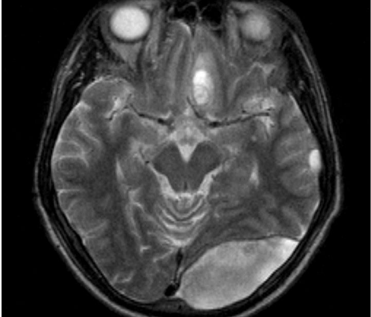 Эпидуральная гематома на МРТ снимке Эпидуральная гематома на МРТ снимке