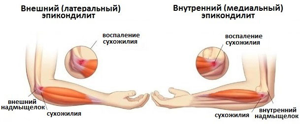 Виды эпикондилита локтевого сустава Виды эпикондилита локтевого сустава
