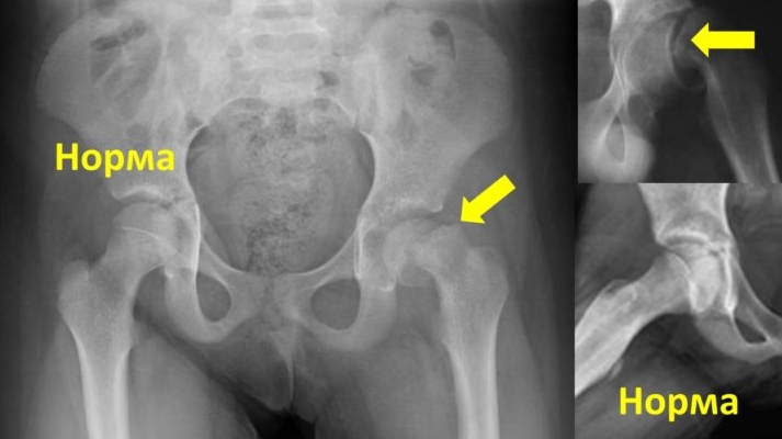 Эпифизеолиз головки тазобедренного сустава на МРТ Эпифизеолиз головки тазобедренного сустава на МРТ