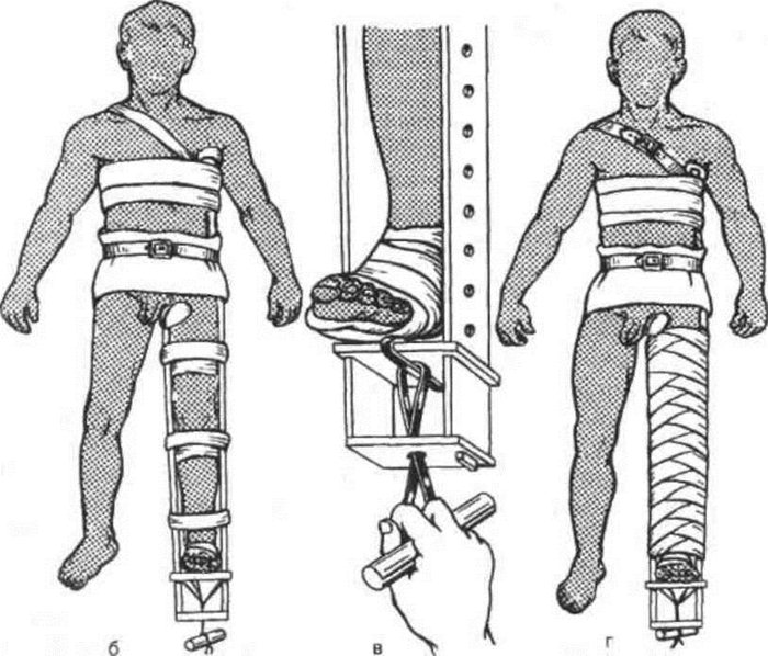 Этапы наложения шины Дитерихса Этапы наложения шины Дитерихса