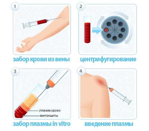 Этапы плазмофитинга Этапы плазмофитинга