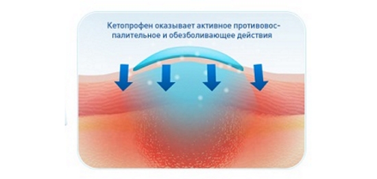 Действие кетопрофена на воспаление