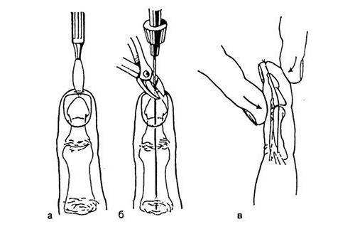 Фиксация спицей пальца Фиксация спицей пальца
