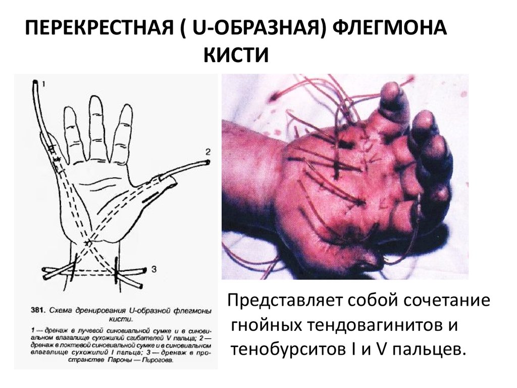 Флегмона кисти Флегмона кисти