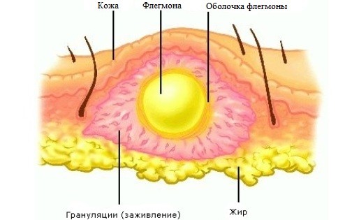 Флегмона Флегмона
