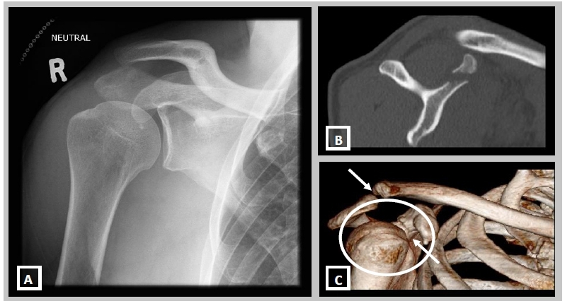 Формирование 3Д снимка плеча на КТ Формирование 3Д снимка плеча на КТ