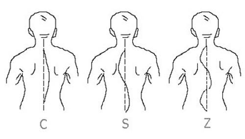 Формы сколиоза Формы сколиоза