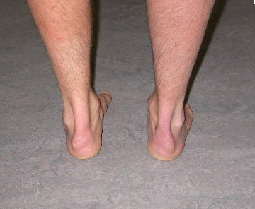 Фото ахиллобурсита Фото ахиллобурсита