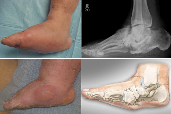 Фото и рентген Стопы Шарко Фото и рентген Стопы Шарко