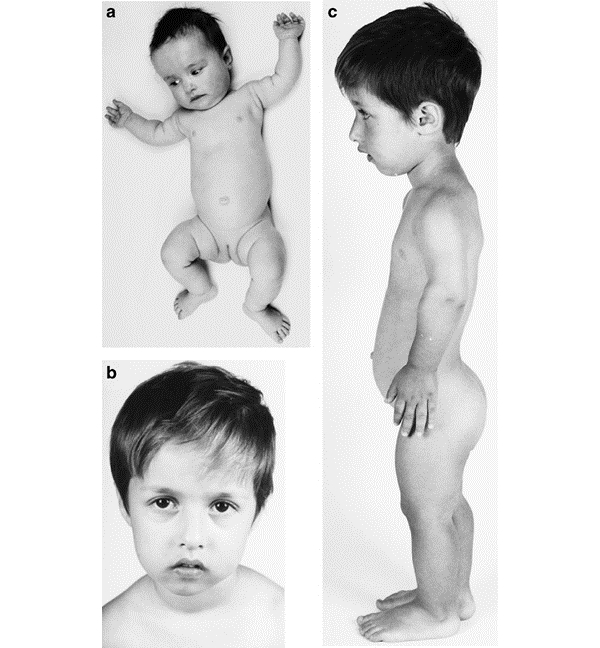 Фото ребенка с гипохондроплазией Фото ребенка с гипохондроплазией