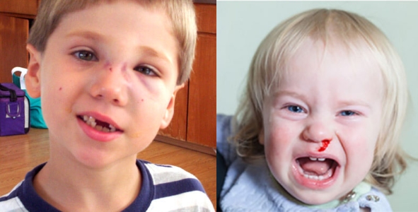 Гематома и кровотечение Гематома и кровотечение