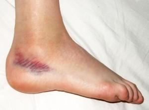 Гематома и опухоль при разрыве связки стопы
