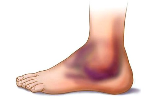 Гематома при разрыве связки голеностопа