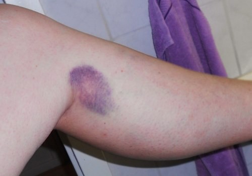 Гематома на икроножной мышце Гематома на икроножной мышце