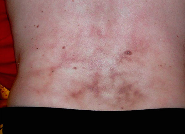 Гематомы на пояснице